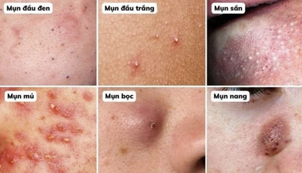 Phân biệt từng loại mụn trứng cá và hướng điều trị đúng theo cơ chế da