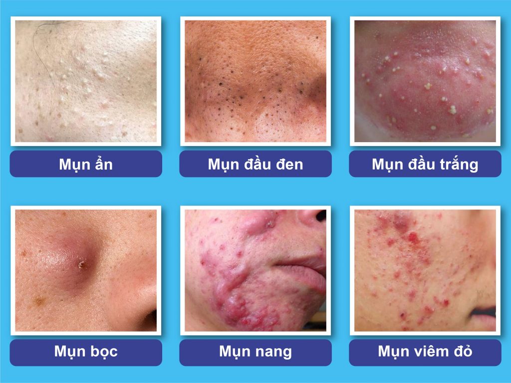 Phác đồ điều trị mụn theo từng giai đoạn: Hiểu đúng để điều trị mụn hiệu quả và bền vững