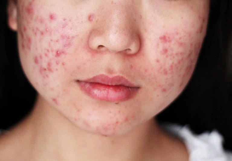 Mụn trứng cá tuổi dậy thì và vòng lặp tái phát kéo dài nhiều năm