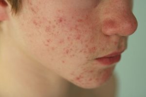 MỤN TRỨNG CÁ CẰM