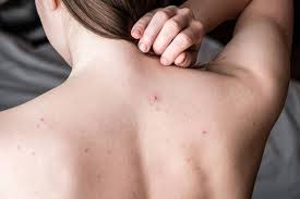 Mụn lưng gây khó chịu