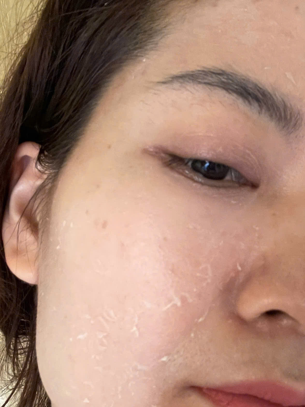 Hiện tượng da sau peel