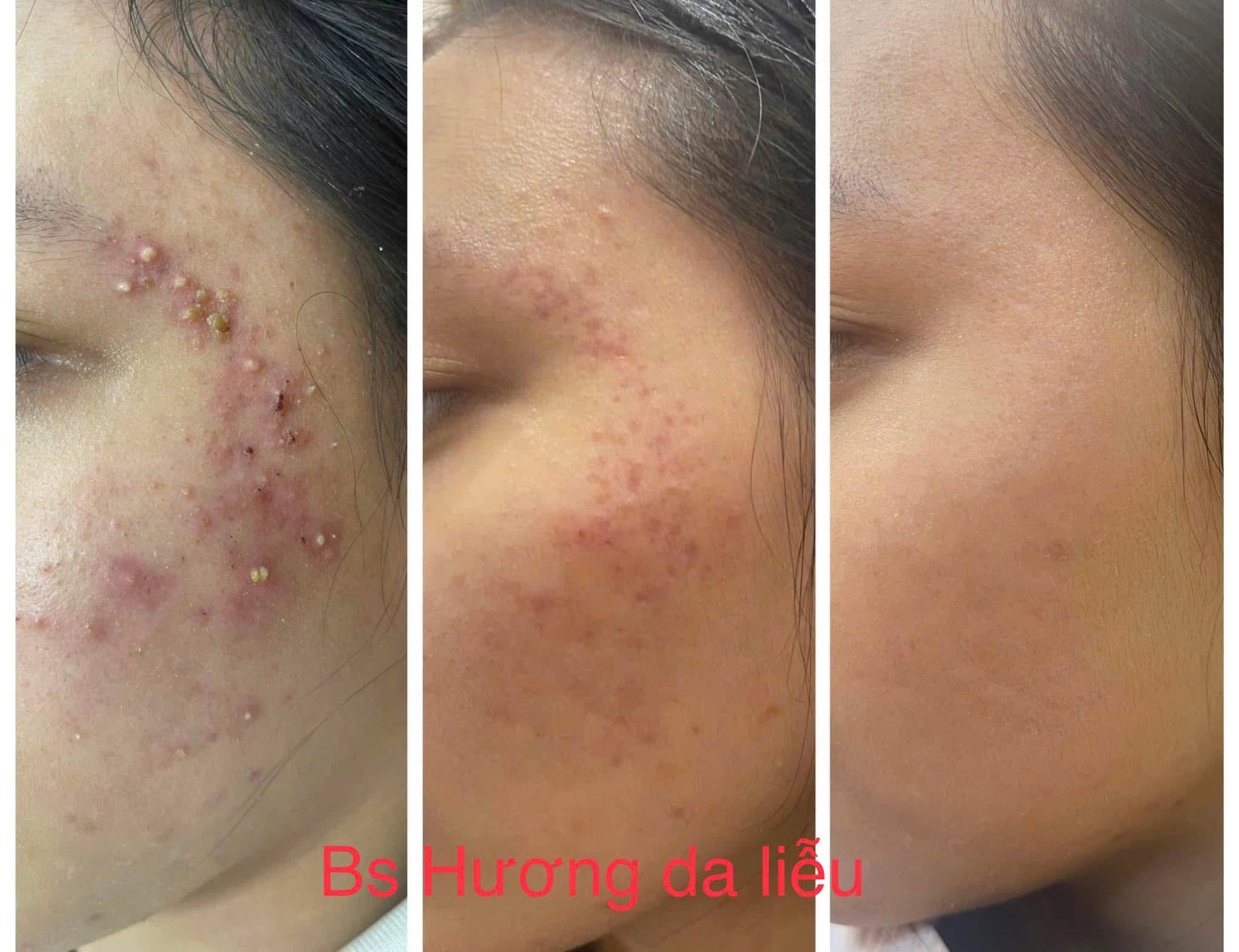 Mụn nội tiết