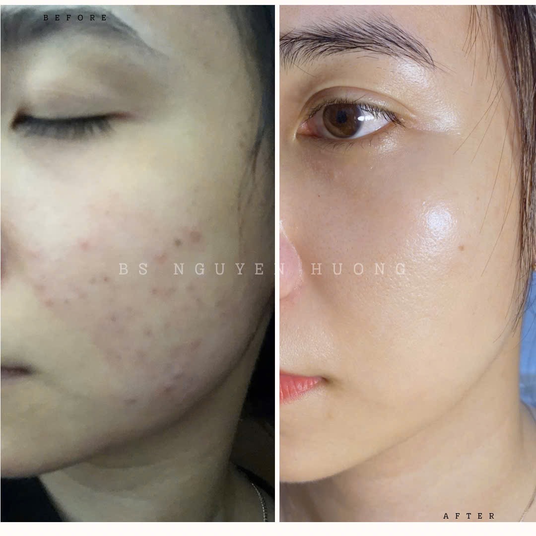 Mụn trứng cá tuổi dậy thì