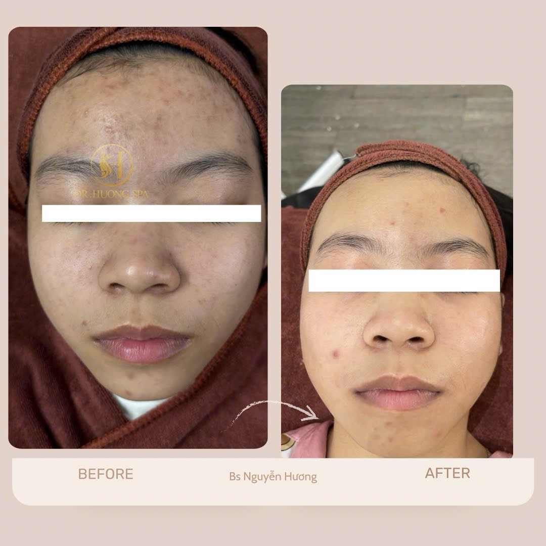 Mụn hình thành như thế nào